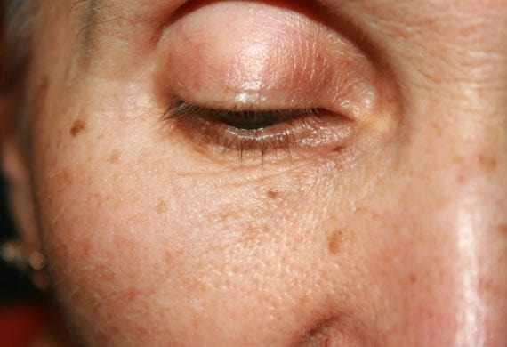 Treatments for sun damaged skin
