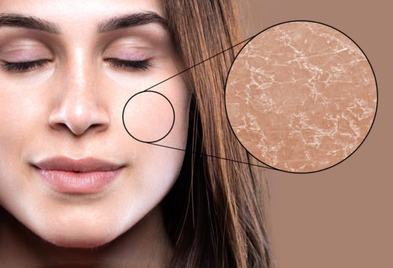 woman, with, dehydrated, skin